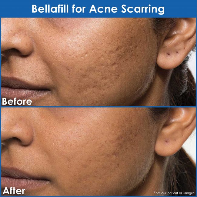 Close-up picture of a person's face before and after being injected with Bellafill